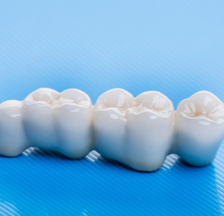 A dental bridge is a prosthetic designed to replace missing consecutive teeth