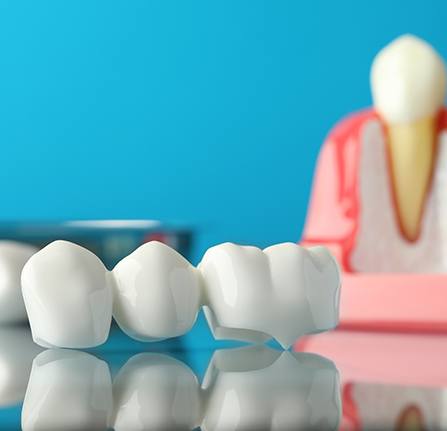 A dental bridge is a series of prosthetic teeth