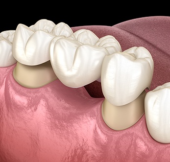 There are several types of dental bridges