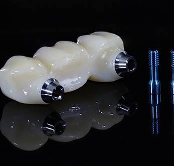 Traditional dental bridges are made from a variety of durable lifelike materials including porcelain