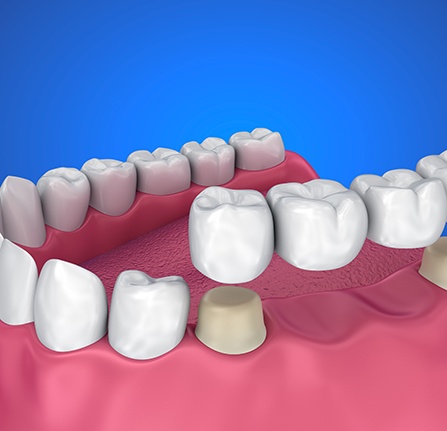 A dental bridge can replace up to four consecutive missing teeth.