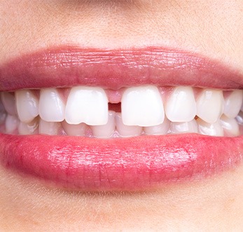 Closeup of a woman smiling with a diastema between front upper incisors