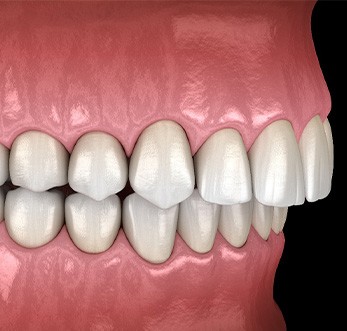 Profile view rendering of an overbite with a black background