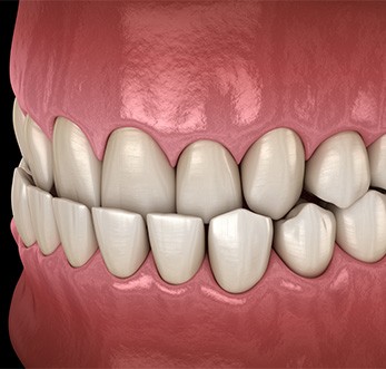 Profile view rendering of an underbite with black background