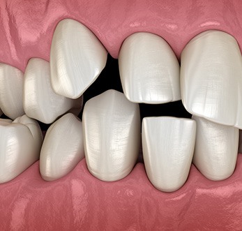 Closeup of a rendering of teeth criss-crossing each other 