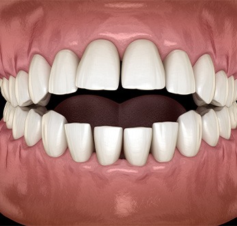 Frontal view rendering of an open bite with black background