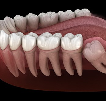 Digital illustration of an impacted wisdom tooth