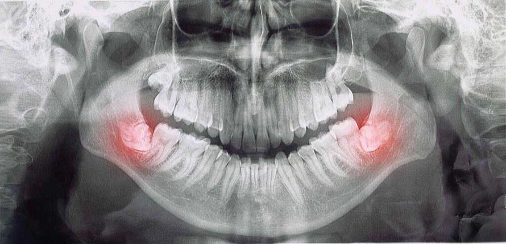 Impacted wisdom teeth X-ray