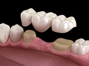 Partial Denture or Dental Bridge: Which One Do I Need?
